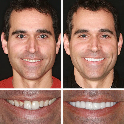 --Ends Today: 75% OFF! ⏰DarkFairy™ Medical Full Denture with Strong Suctiond Custom-Fit Full Functional Dentures🦷Obtain American Dental Association (ADA) Certification