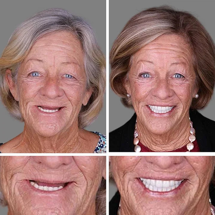 --Ends Today: 75% OFF! ⏰DarkFairy™ Medical Full Denture with Strong Suctiond Custom-Fit Full Functional Dentures🦷Obtain American Dental Association (ADA) Certification