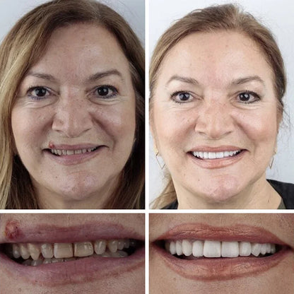 --Ends Today: 75% OFF! ⏰DarkFairy™ Medical Full Denture with Strong Suctiond Custom-Fit Full Functional Dentures🦷Obtain American Dental Association (ADA) Certification