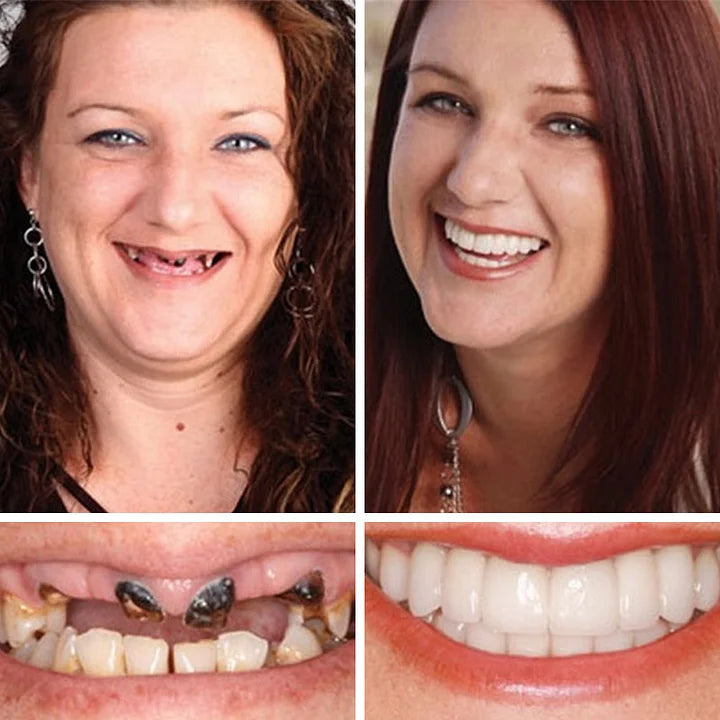 --Ends Today: 75% OFF! ⏰DarkFairy™ Medical Full Denture with Strong Suctiond Custom-Fit Full Functional Dentures🦷Obtain American Dental Association (ADA) Certification