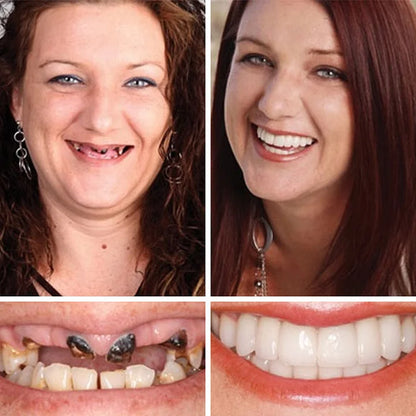 --Ends Today: 75% OFF! ⏰DarkFairy™ Medical Full Denture with Strong Suctiond Custom-Fit Full Functional Dentures🦷Obtain American Dental Association (ADA) Certification